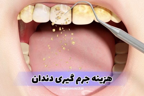 قیمت جرم گیری دندان در تبریز در سال ۱۴۰۴ چقدر است؟ در این مقاله با هزینه به‌روز، تفاوت جرم گیری و پالیش، مزایا، و پاسخ به سوالات متداول آشنا شوید.