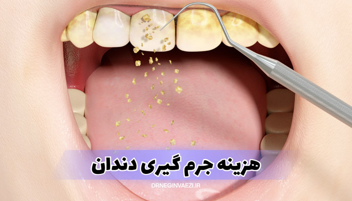 قیمت جرم گیری دندان در تبریز در سال ۱۴۰۴ چقدر است؟ در این مقاله با هزینه به‌روز، تفاوت جرم گیری و پالیش، مزایا، و پاسخ به سوالات متداول آشنا شوید.