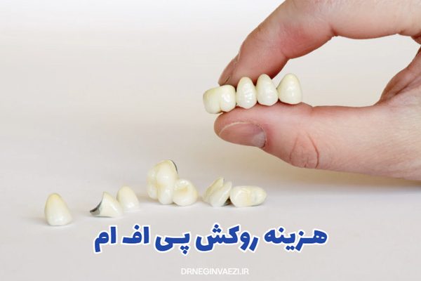 هزینه روکش پی اف ام در تبریز,قیمت روکش دندان تبریز,هزینه روکش pfm ایمپلنت ,یمت روکش ایمپلنت,قیمت روکش در تبریز برای دندان,دکتر نگین واعظی