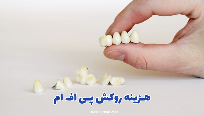 هزینه روکش پی اف ام در تبریز,قیمت روکش دندان تبریز,هزینه روکش pfm ایمپلنت ,یمت روکش ایمپلنت,قیمت روکش در تبریز برای دندان,دکتر نگین واعظی