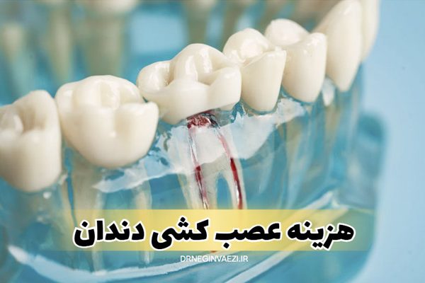 هزینه عصب کشی دندان در تبریز,هزینه درمان ریشه در تبریز,هزینه عصب کشی تک کانال دو کانال سه کانال چهار کانال دندان عقل در تبریز,نوبت دهی سریع عصب کشی در تبریز دکتر نگین واعظی