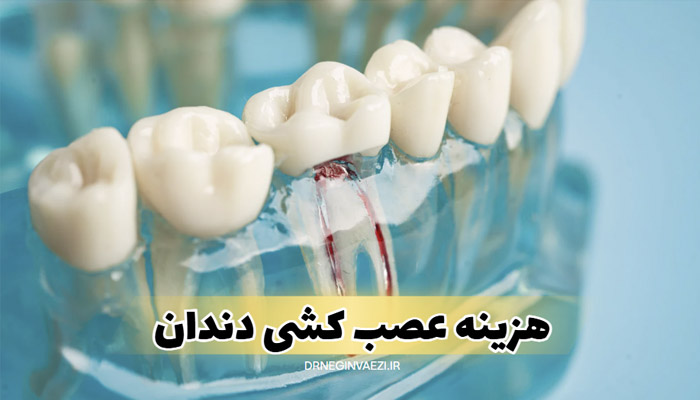 هزینه عصب کشی دندان در تبریز,هزینه درمان ریشه در تبریز,هزینه عصب کشی تک کانال دو کانال سه کانال چهار کانال دندان عقل در تبریز,نوبت دهی سریع عصب کشی در تبریز دکتر نگین واعظی