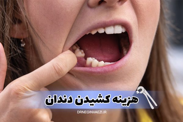 اگر به دنبال هزینه کشیدن دندان در تبریز در سال ۱۴۰۴ هستید، این مقاله راهنمای کامل قیمت ها، انواع کشیدن دندان، نکات مراقبتی و آدرس مطب دندانپزشکی ما را در اختیارتان قرار می‌دهد.