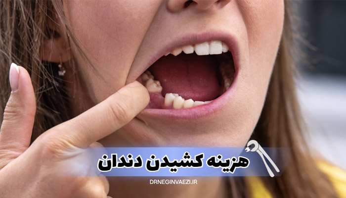 اگر به دنبال هزینه کشیدن دندان در تبریز در سال ۱۴۰۴ هستید، این مقاله راهنمای کامل قیمت ها، انواع کشیدن دندان، نکات مراقبتی و آدرس مطب دندانپزشکی ما را در اختیارتان قرار می‌دهد.