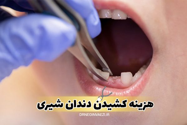 قیمت کشیدن دندان شیری در تبریز کشیدن دندان شیری کودک دندانپزشکی کودکان تبریز هزینه کشیدن دندان شیری