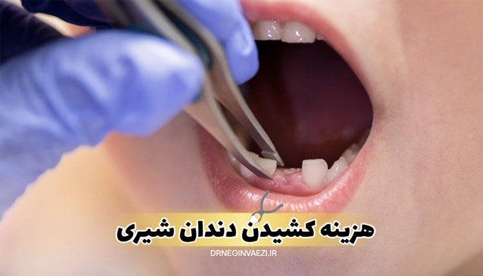 قیمت کشیدن دندان شیری در تبریز کشیدن دندان شیری کودک دندانپزشکی کودکان تبریز هزینه کشیدن دندان شیری