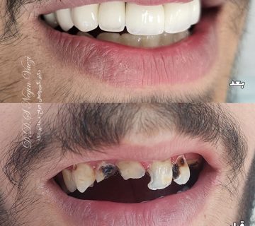 نمونه کار روکش زیرکونیا تمام سرامیکی در تبریز و بازسازی لبخند بیمار