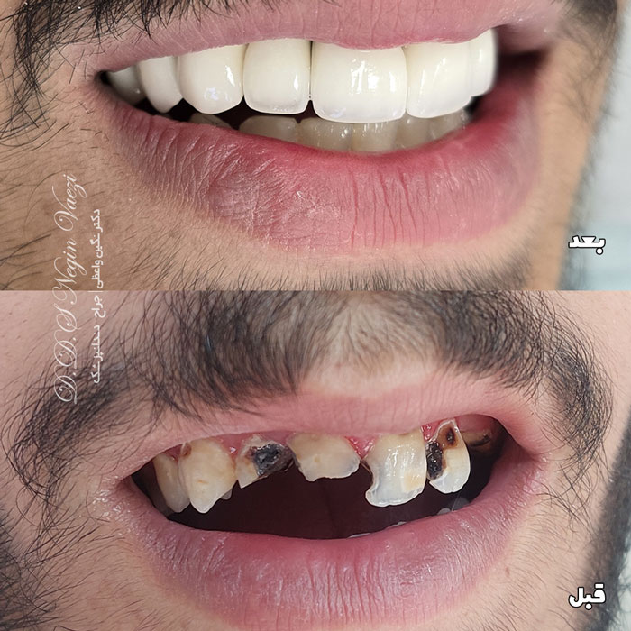 نمونه کار روکش زیرکونیا تمام سرامیکی در تبریز و بازسازی لبخند بیمار