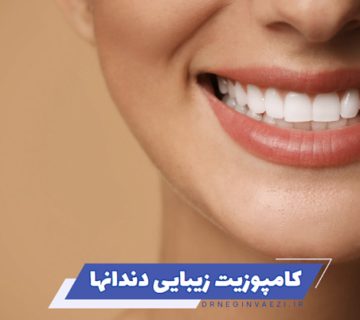 کامپوزیت زیبایی دندانها در تبریز و معرفی بهترین دندانپزشک ونیر کامپوزیت در ولیعصر تبریز برای اصلاح طرح لبخند و بازسازی دندان ها در دندانپزشکی زیبایی