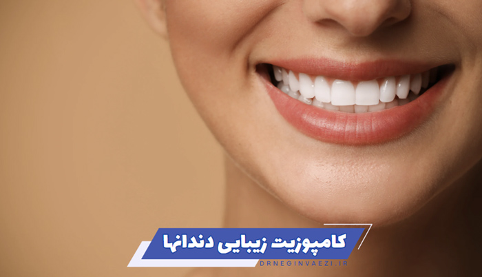 کامپوزیت زیبایی دندانها در تبریز و معرفی بهترین دندانپزشک ونیر کامپوزیت در ولیعصر تبریز برای اصلاح طرح لبخند و بازسازی دندان ها در دندانپزشکی زیبایی