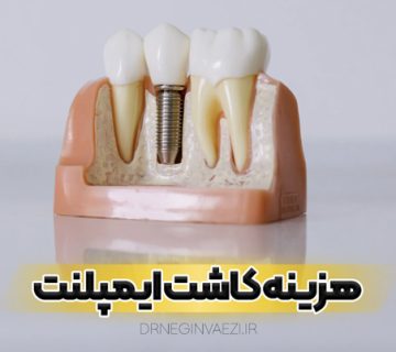 بهترین روکش ایمپلنت تبریز - جدول قیمت و هزینه کاشت ایمپلنت دندان در تبریز