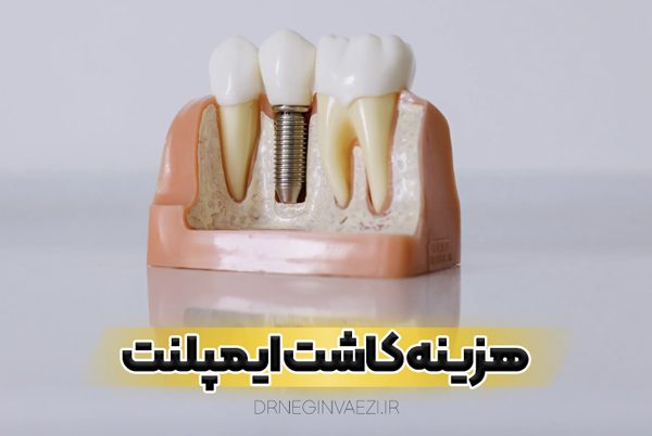 بهترین روکش ایمپلنت تبریز - جدول قیمت و هزینه کاشت ایمپلنت دندان در تبریز