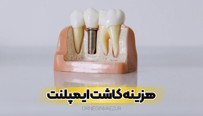 بهترین روکش ایمپلنت تبریز جدول قیمت و هزینه کاشت ایمپلنت دندان در تبریز