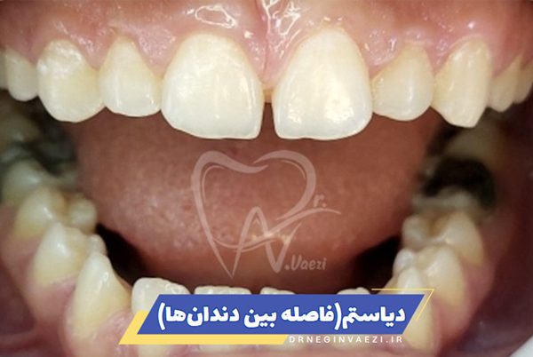 تصویر دیاستم یا فاصله بین دندان ها - روش های درمان و معرفی دندناپزشک در تبریز