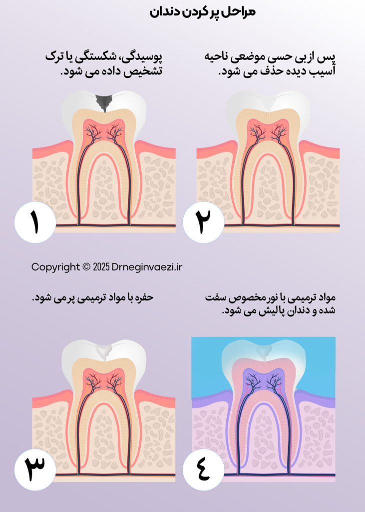 عکس مراحل پر کردن دندان