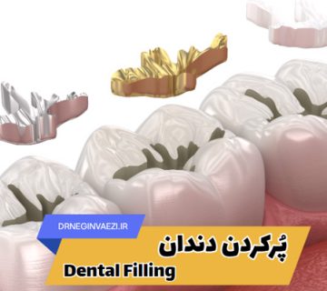 پرکردن دندان چیست؟ انواع پر کردن و ترمیم، ترمیم دندان دندانپزشکی در تبریز ، دندانپزشکی ترمیمی دکتر نگین واعظی