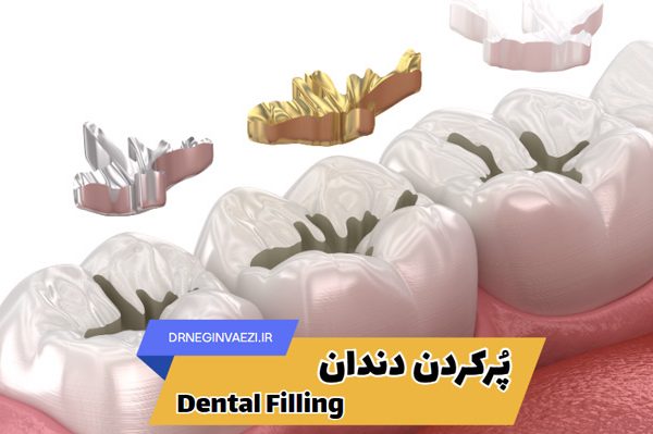 پرکردن دندان چیست؟ انواع پر کردن و ترمیم، ترمیم دندان دندانپزشکی در تبریز ، دندانپزشکی ترمیمی دکتر نگین واعظی