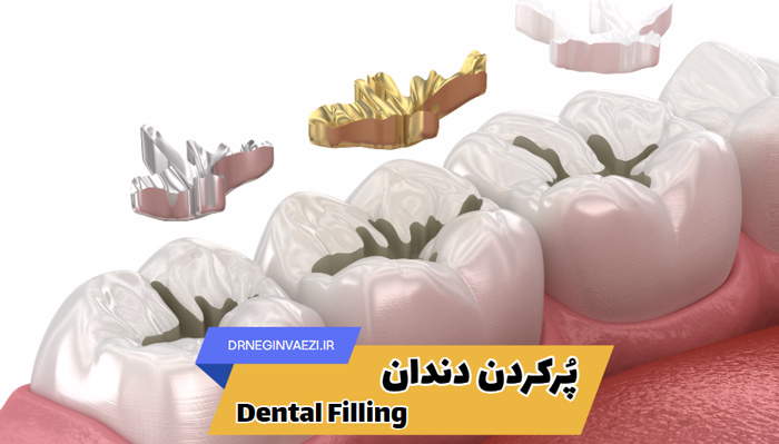 پرکردن دندان چیست؟ انواع پر کردن و ترمیم، ترمیم دندان دندانپزشکی در تبریز ، دندانپزشکی ترمیمی دکتر نگین واعظی