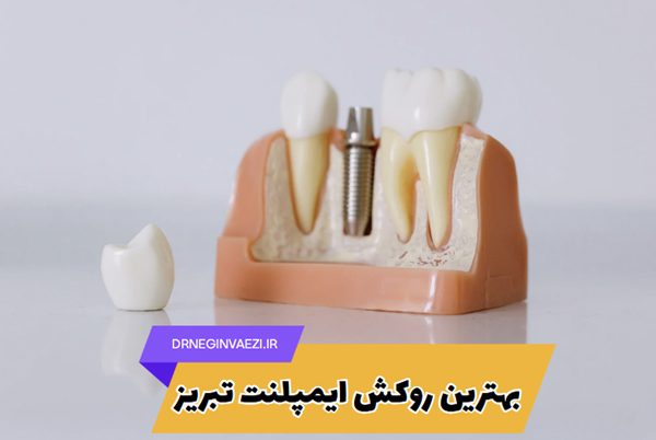 بهترین روکش ایمپلنت در تبریز - مطب دکتر نگین واعظی - هزینه روکش زیرکونیا و پی اف ام و E-max