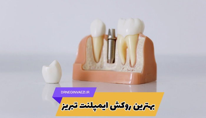 بهترین روکش ایمپلنت در تبریز - مطب دکتر نگین واعظی - هزینه روکش زیرکونیا و پی اف ام و E-max