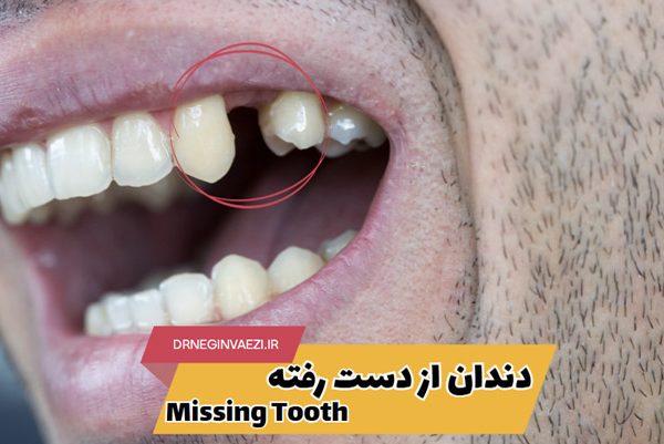 جایگزین دندان از دست رفته در تبریز با ایمپلنت ، بریج دندانی و دندان مصنوعی - بهترین جایگزین دندان کشیده شده چیست؟