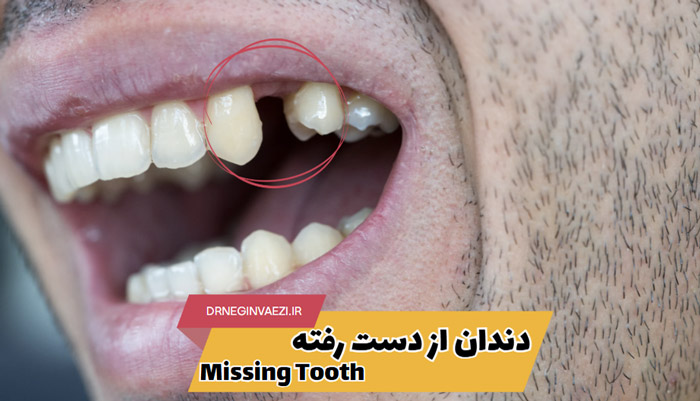 جایگزین دندان از دست رفته در تبریز با ایمپلنت ، بریج دندانی و دندان مصنوعی - بهترین جایگزین دندان کشیده شده چیست؟