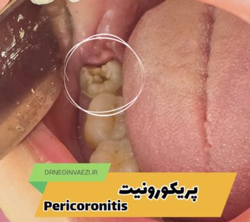 نمای شماتیک پریکورونیت: التهاب لثه اطراف دندان عقل نهفته pericoronitis
