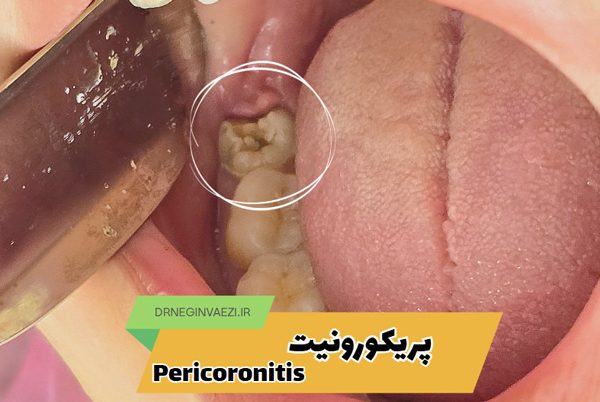 نمای شماتیک پریکورونیت: التهاب لثه اطراف دندان عقل نهفته pericoronitis