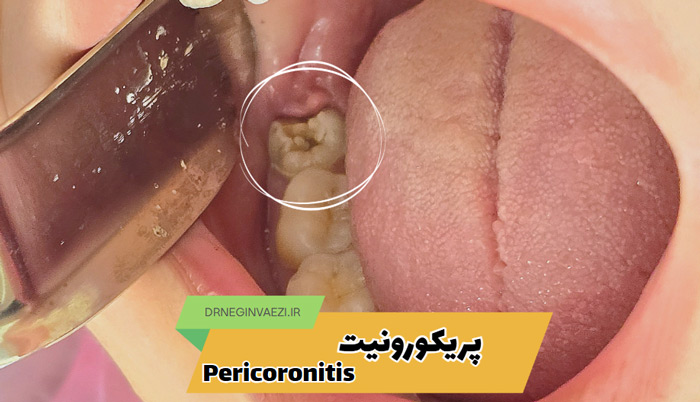 نمای شماتیک پریکورونیت: التهاب لثه اطراف دندان عقل نهفته pericoronitis