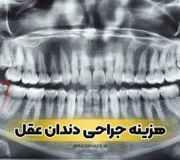 جراحی دندان عقل نهفته در تبریز با بهترین قیمت امسال توسط دکتر نگین واعظی