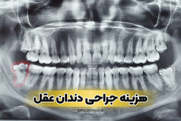 جراحی دندان عقل نهفته در تبریز با بهترین قیمت امسال توسط دکتر نگین واعظی
