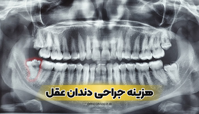 جراحی دندان عقل نهفته در تبریز با بهترین قیمت امسال توسط دکتر نگین واعظی