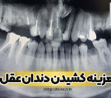 کشیدن دندان عقل در مطب دندانپزشکی تبریز با هزینه مناسب در سال 1404 - 1405 - 1406 -1407 - امسال