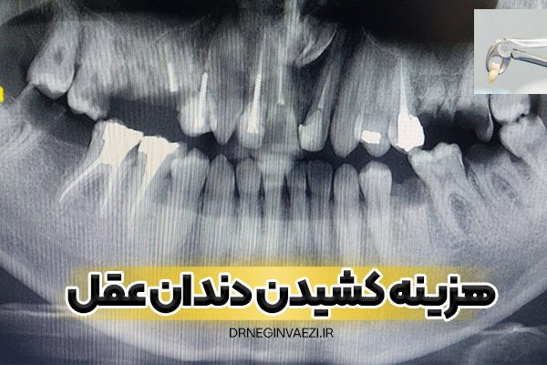 کشیدن دندان عقل در مطب دندانپزشکی تبریز با هزینه مناسب در سال 1404 - 1405 - 1406 -1407 - امسال