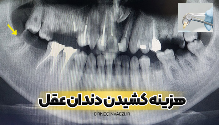 کشیدن دندان عقل در مطب دندانپزشکی تبریز با هزینه مناسب در سال 1404 - 1405 - 1406 -1407 - امسال