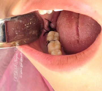 نمونه جراحی دندان عقل نیمه نهفته فک پایین در تبریز توسط دکتر نگین واعظی جراح و دندانپزشک در ولیعصر