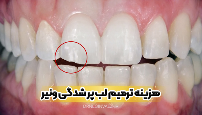 شکستگی ونیر,ترمیم ونیر کامپوزیت,ترمیم لب پرشدگی,دندانپزشکی زیبایی,ترمیم دندان تبریز