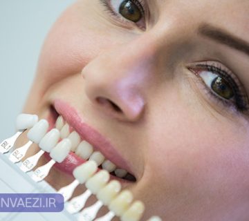 ۵ اشتباه رایج بعد از ونیر کامپوزیت دندان که باعث شکست درمان می‌شود