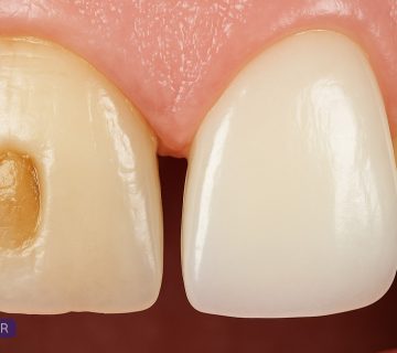 فرق کامپوزیت با کامپوزیرت ونیر و تصویر قبل و بعد از اجرای ونیر کامپوزیتی روی دندان‌های جلو