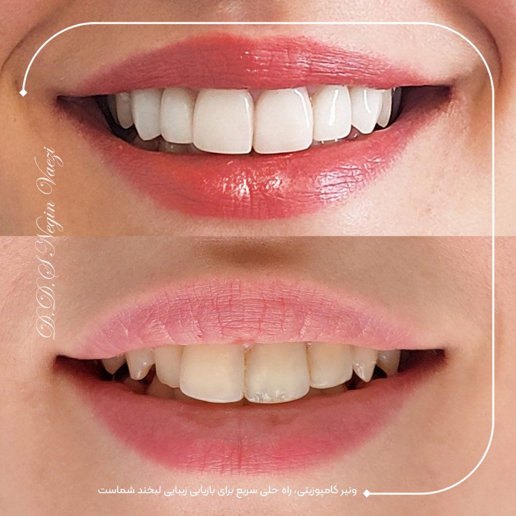 نمونه کار ونیر کامپوزیت بهترین دکتر کامپوزیت دندان در تبریز - عکس قبل و بعد