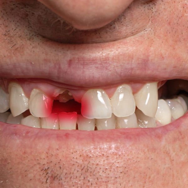 روش های جایگزینی دندان جلو در تبریز با ایمپلنت ، ترمیم و بریج دندانی توسط دکتر نگین واعظی