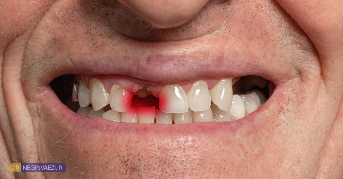 روش های جایگزینی دندان جلو در تبریز با ایمپلنت ، ترمیم و بریج دندانی توسط دکتر نگین واعظی