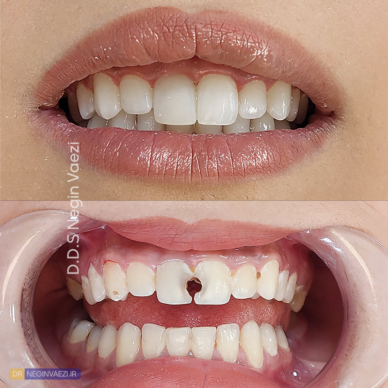ترمیم دندان جلو در تبریز باندینگ با کامپوزیت توسط دکتر نگین واعظی