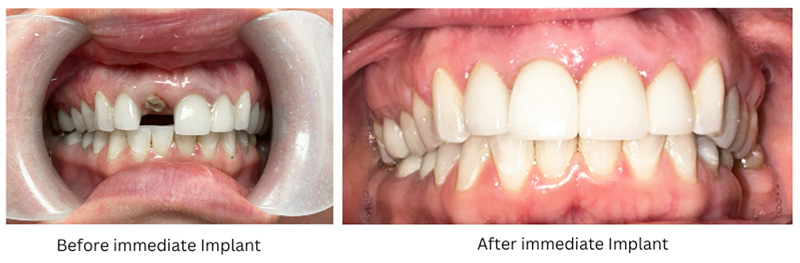 ایمپلنت فوری دندان در تبریز - immediate-implant-tabriz - ایمپلنت یک روزه