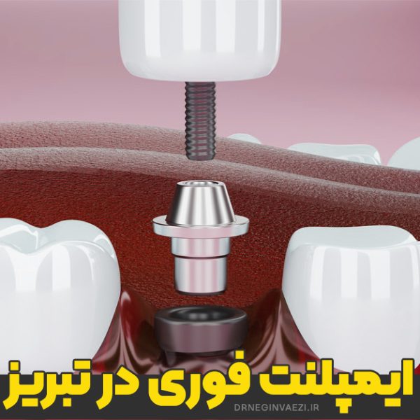 کاشت ایمپلنت فوری دندان در تبریز پس از کشیدن دندان با حفظ زیبایی لبخند