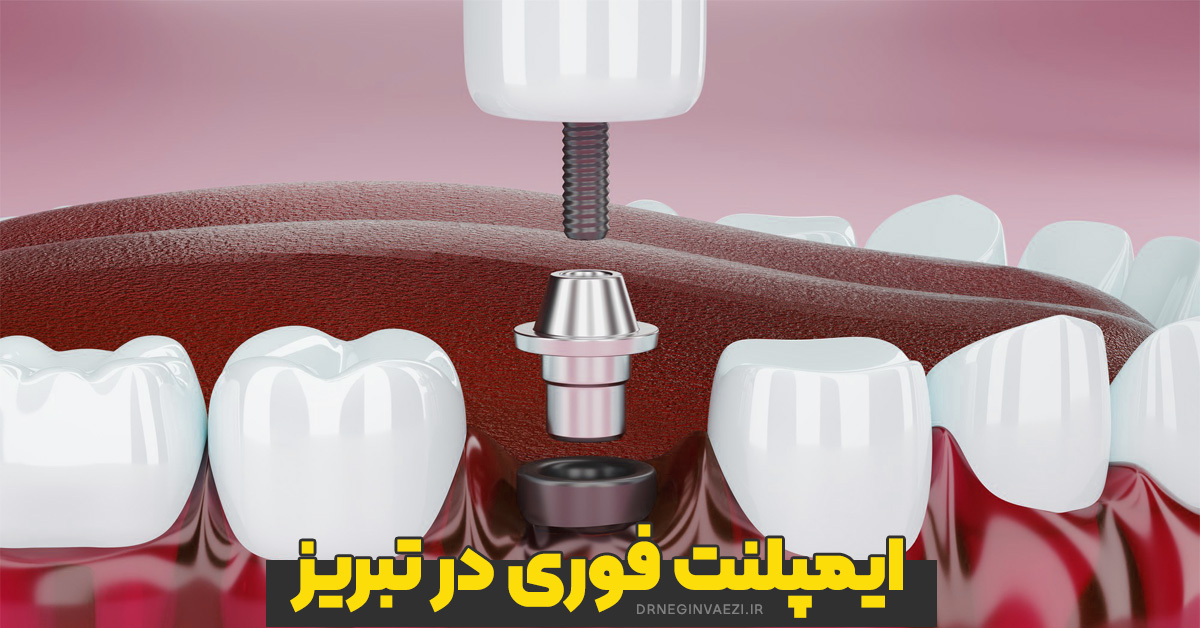 کاشت ایمپلنت فوری دندان در تبریز پس از کشیدن دندان با حفظ زیبایی لبخند