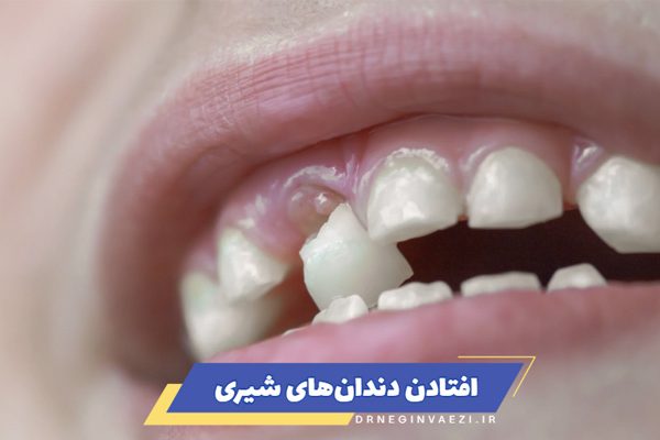 اولین دندان لق کودک کی می‌افتد؟ ترتیب افتادن دندان های شیری کودک