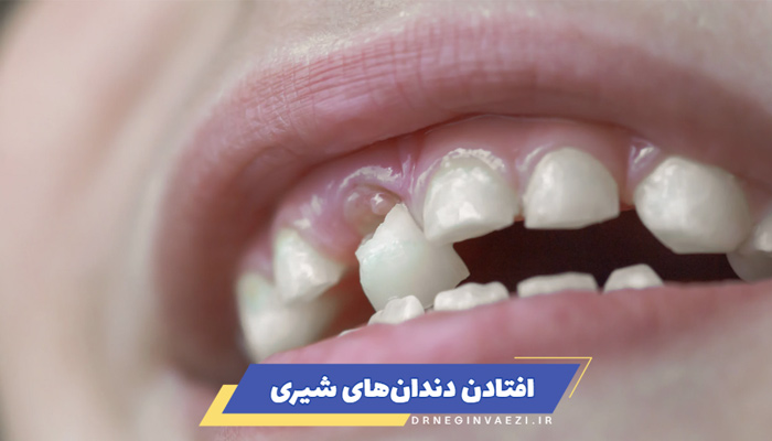 اولین دندان لق کودک کی می‌افتد؟ ترتیب افتادن دندان های شیری کودک