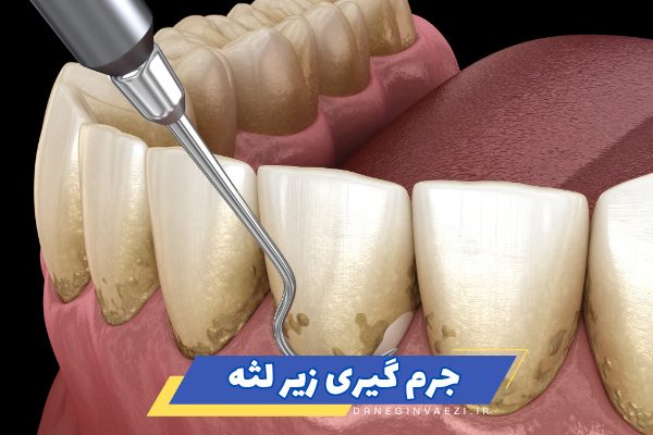 نحوه انجام جرم گیری زیر لثه برای پیشگیری از بیماریهای لثه