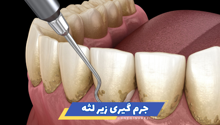 نحوه انجام جرم گیری زیر لثه برای پیشگیری از بیماریهای لثه